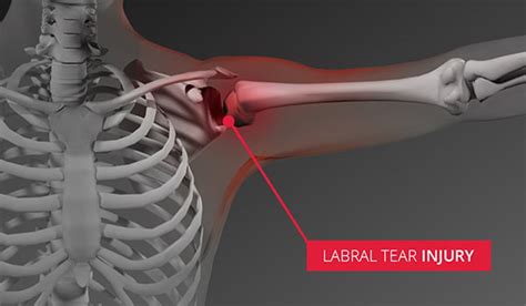 tests for labral tear shoulder|degenerative labral tear shoulder.